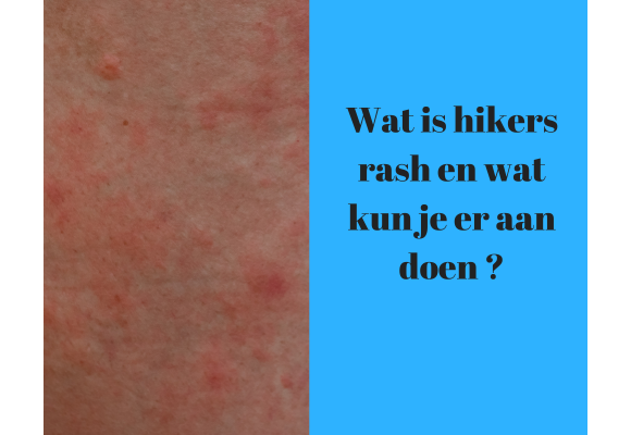 Wat is hikers rash en wat kun je er aan doen?